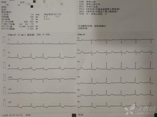 患者口服 300 片地高辛,全程心电图如何演变?