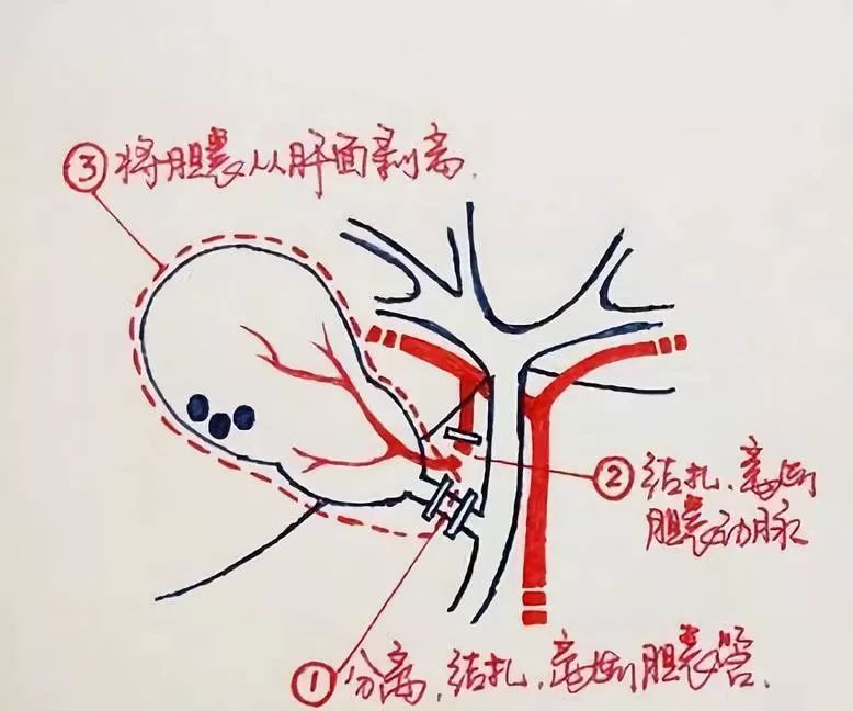 胆囊简笔画图片